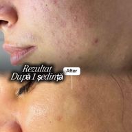 Rezultat ten după o ședință de tratament facial DermiQ